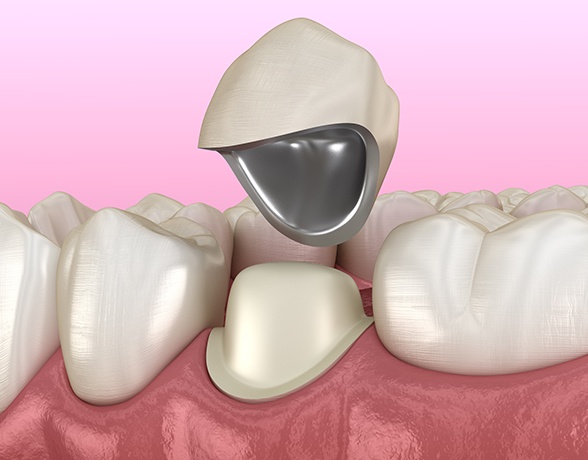 3D render of a dental crown being placed on a tooth