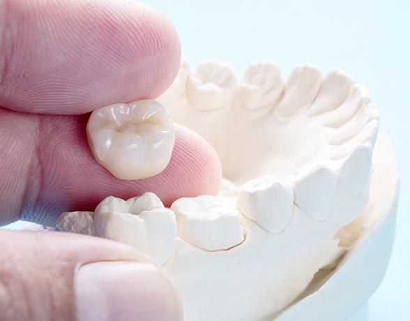Dental crown on model teeth