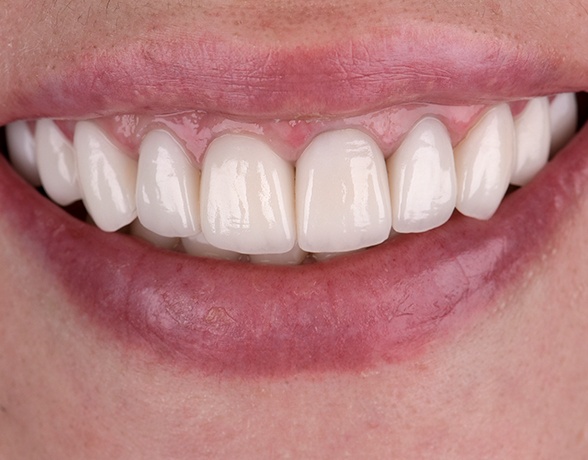 Closeup of smile with damage indicating a need for gum disease treatment