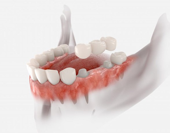 A 3D illustration of a traditional dental bridge