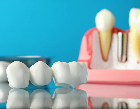 A dental bridge model on a glass table