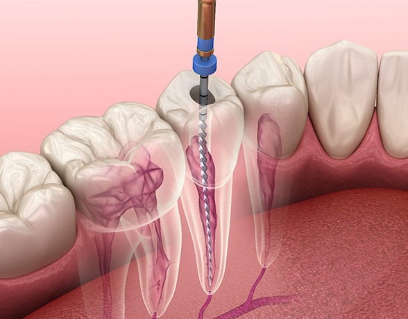 Illustration of root canal therapy for lower arch