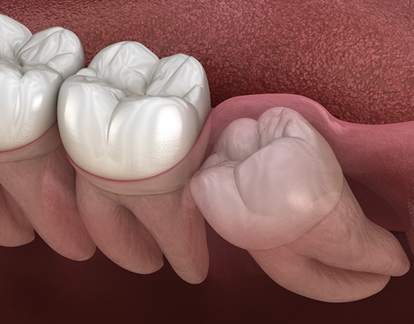 Illustration of impacted wisdom tooth in lower arch