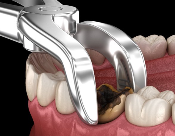 illustration of decayed tooth extraction  