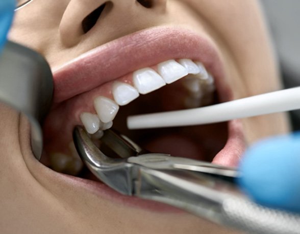 woman having a tooth extracted    