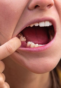 a person showing their missing tooth