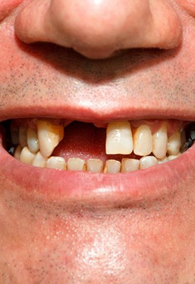 Man smiling to reveal a missing tooth