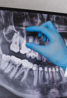 Dentist pointing out a patient’s dental root on an X-ray