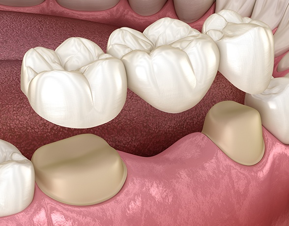 Animated dental implant supported fixed bridge placement