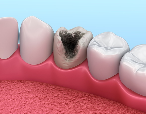 Animated smile with tooth decay before silver diamine fluoride treatment