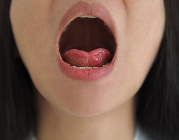 Closeup of smile before treatment for lip and tongue tie