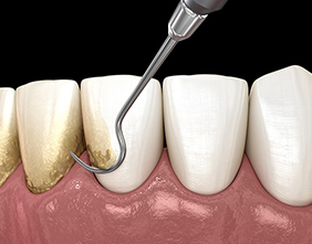 Animated smile during scaling and root planing treatment