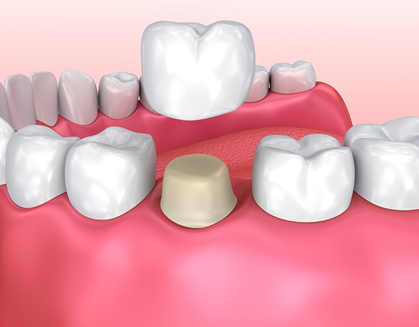 Animated smile during dental crown placement