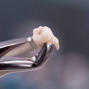 an extracted tooth held by dental forceps